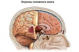 Рак мозга: признаки и симптомы. Первые признаки рака головного мозга