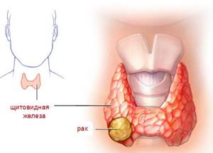 Карцинома щитовидной железы