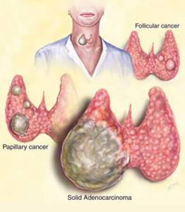 Типы рака щитовидной железы