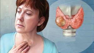 Злокачественное образование щитовидной железы