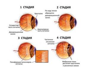 Стадии ретинопатии