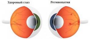 Разновидности, причины, симптомы и лечение ретинопатии сетчатки глаза