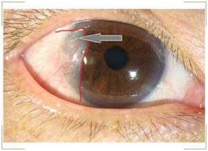 Разновидности, причины, симптомы и лечение ретинопатии сетчатки глаза