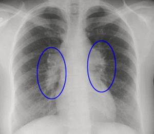 Саркоидоз лёгких, что это такое: современные представления о причинах, методах диагностики и лечения