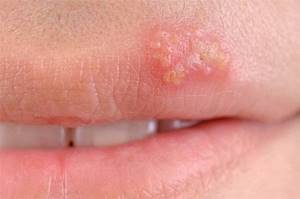 Герпес на губах - один из симптомов сепсиса