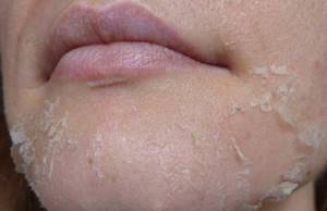 Шелушится кожа на лице – что делать и как этого избежать?