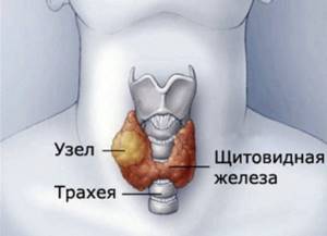 Узлы на щитовидной железе, лечение лекарственными препаратами, малоинвазивными методами и с помощью хирургического вмешательства