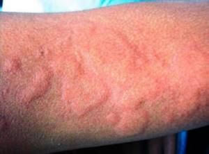 Симптомы аллергии — первые проявления, причины аллергии, прием препаратов широкого спектра действия и узконаправленное лечение (120 фото)