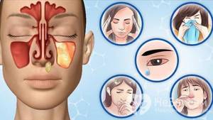 При появлении характерных признаков можно предположить начало развития воспаления в верхнечелюстных пазухах носа