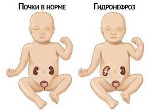 Симптомы гидронефроза почек у новорожденных и детей старше года, методы лечения и исход заболевания