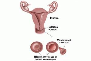 Симптомы и признаки рака шейки матки на ранней стадии