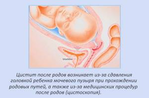Симптомы и способы лечения появившегося после родов цистита