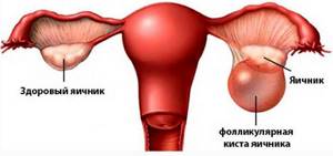 кистозное образование на яичнике у женщин