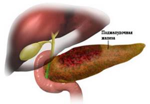 Симптомы панкреонекроза поджелудочной железы и шансы выжить