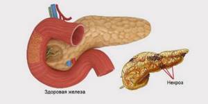 Панкреонекроз поджелудочной железы: симптомы и признаки, лечение, операция, шансы выжить