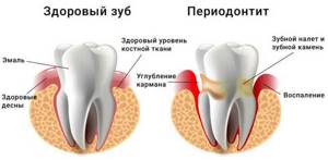 здоровый зуб и периодонтит