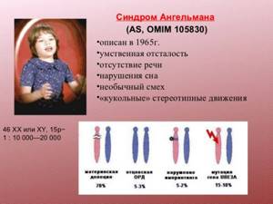 Симптомы, признаки и лечение синдрома Счастливой куклы (Ангельмана)