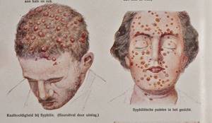 Симптомы, признаки сифилиса у женщин и мужчин. Как лечить сифилис