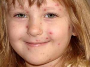 Симптомы вирусной и внезапной экзантемы у детей: фото сыпи и принципы лечения кожной инфекции