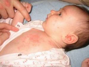 Симптомы вирусной и внезапной экзантемы у детей: фото сыпи и принципы лечения кожной инфекции