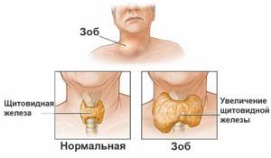 Симптомы заболевания щитовидной железы у женщин, первые признаки, лечение медикаментами и народными средствами