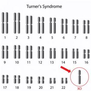 Синдром Шерешевского-Тёрнера – причины, симптомы, диагностика и способы лечения