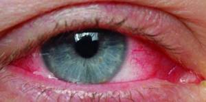 Синдром сухого глаза: симптомы, лечение, лучшие капли