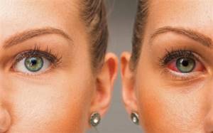 Синдром сухого глаза: симптомы, лечение, лучшие капли