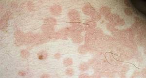 Сыпь на коже: как по высыпаниям определить, чем болеет человек