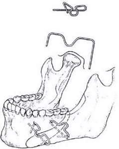 Иммобилизация отломков нижней челюсти с помощью скоб из металла с заранее заданными свойствами