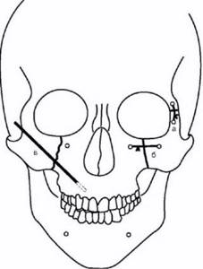 Остеосинтез отломков верхней челюсти с помощью костного шва и спицы