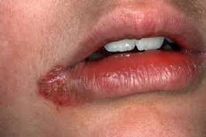 Трескаются уголки губ. Причины, лечение, сохнут по бокам, в середине, шелушатся, каких витаминов не хватает