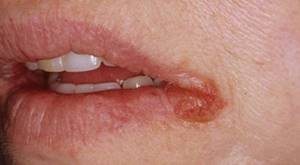 Трескаются уголки губ. Причины, лечение, сохнут по бокам, в середине, шелушатся, каких витаминов не хватает