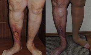 Трофические язвы на ногах. Фото, лечение, почему образуются, чем мазать