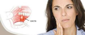 Цистотомия кисты зуба