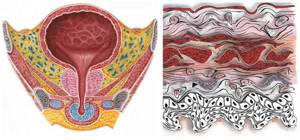 Утолщение стенок мочевого пузыря: причины, разновидности, как диагностируется на УЗИ