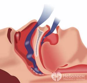 Затрудненное дыхание при вазомоторном рините может становится причиной апноэ сна