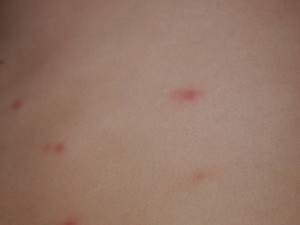 Виды кожных высыпаний у детей: фото сыпи на груди, спине и по всему телу с пояснениями