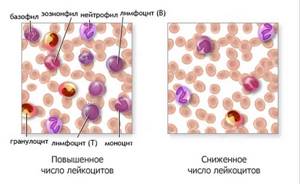 Повышенное содержание лейкоцитов в крови