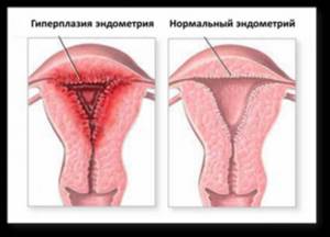 пример гиперплазия эндометрия