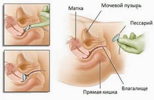 Выпадение матки у женщин: симптомы и признаки, последствия и образ жизни