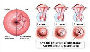 Стадии неопластического процесса шейка матки при ВПЧ