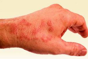 Высыпания на коже при дисбактериозе у детей и их лечение