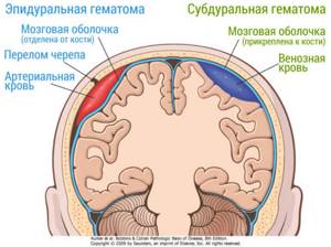 Виды гематом внутри черепа