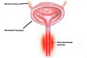 Воспаление мочевыводящих путей у мужчин симптомы лечение