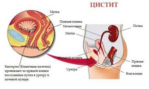 Воспаление мочевого пузыря – симптомы и лечение у женщин, лекарства