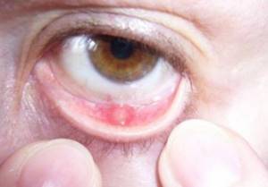 Воспаление верхнего и нижнего века глаза – лечение