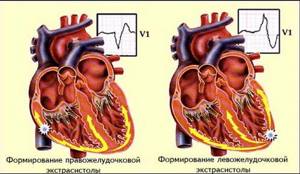 Все факты об экстрасистолии сердца: что это такое и как лечить