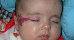 почему возникает гемангиома на лице у ребенка