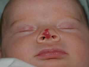 Все о гемангиомах у новорожденных детей: причины возникновения, методы лечения и последствия